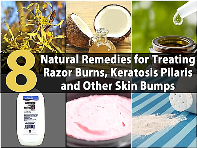 रेजर बर्न्स, केराटोसिस पिलारिस और अन्य त्वचा के धक्कों के उपचार के लिए 8 प्राकृतिक उपचार