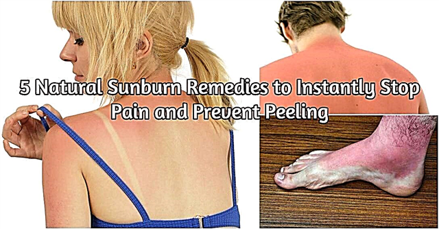 5 natürliche Sonnenbrandmittel, um Schmerzen sofort zu stoppen und Peeling zu verhindern